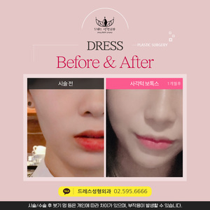 사각턱보톡스