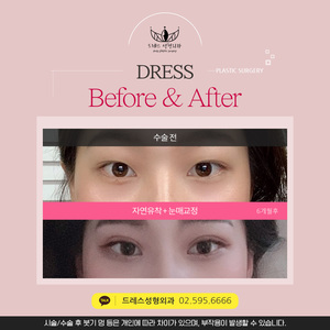 자연유착+눈매교정