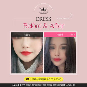 턱필러