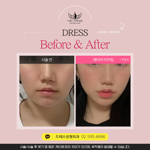 레이저리프팅