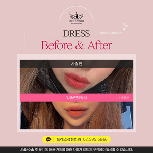 입술전체필러