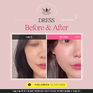 팔자필러