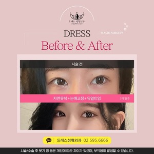 자연유착+눈매교정+듀얼트임
