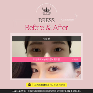 자연유착+눈매교정+윗트임