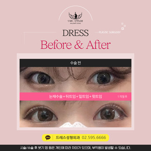 눈재수술+뒤트임+밑트임+윗트임