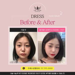 팔자필러 + 윤곽주사 + 리프테라