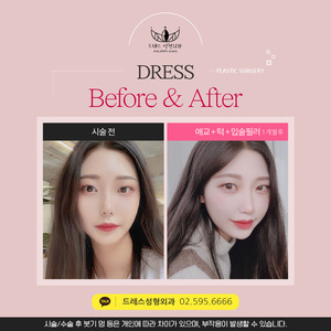애교 + 턱 + 입술필러