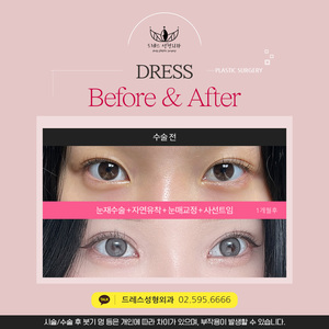 눈재수술 + 자연유착 + 눈매교정 + 사선트임