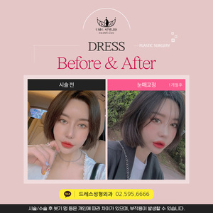 눈매교정