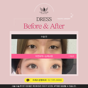 자연유착 + 눈매교정