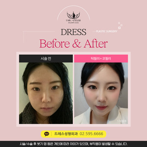 턱필러 + 코필러