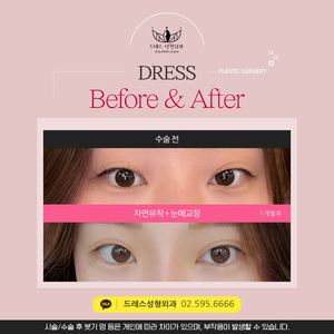 자연유착 + 눈매교정