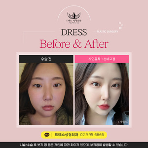 자연유착 + 눈매교정