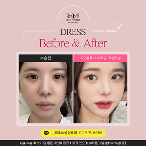 자연유착 + 사선트임 + 듀얼트