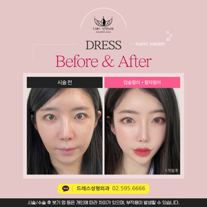 입술필러 + 팔자필러