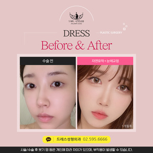 자연유착 + 눈매교정