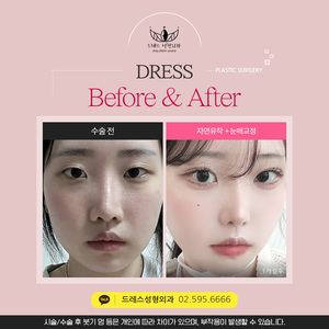 자연유착 + 눈매교정