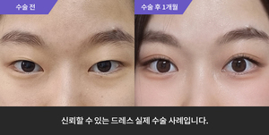 자연유착 재수술 + 눈매교정