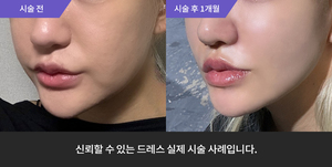 실리프팅