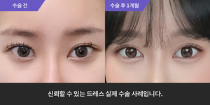 자연유착 재수술