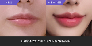 입술필러
