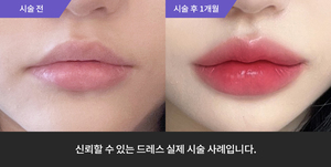 입술필러
