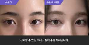 자연유착 재수술 + 눈매교정