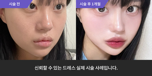 하이코SET,+ 눈밑필러 + 암살주사