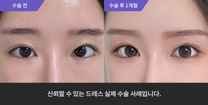 자연유착 + 눈매교정 재수술 + 윗트임