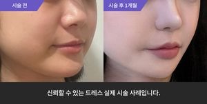 입술필러 + 코필러 + 팔자필러