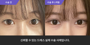 자연유착 재수술 + 눈매교정 재수술