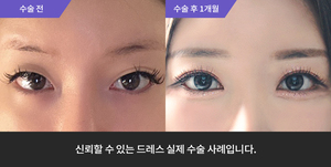 자연유착 + 눈매교정