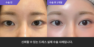 자연유착 재수술 + 눈매교정