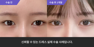 자연유착 재수술 + 윗트임