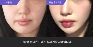 울쎄라