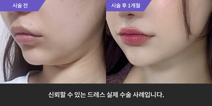 리프테라 + 슈링크