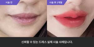 입술필러