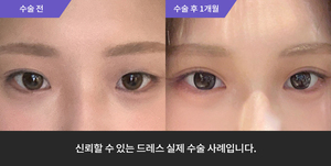 자연유착 + 눈매교정 + 윗트임