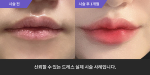 입술필러