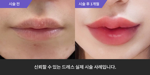 입술필러