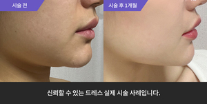 울쎄라 + 암살주사