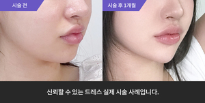턱필러 + 티타늄