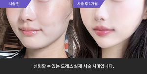 풀페이스필러 +  티타늄