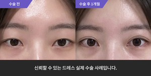 자연유착재수술 + 눈매교정 + 뒤트임