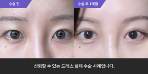 자연유착재수술 + 앞트임 + 윗트임
