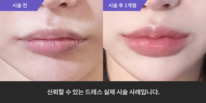 입술필러