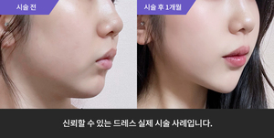 포텐자리프팅 + 암살주사