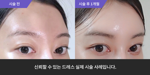 이마필러