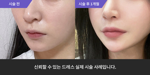 턱필러 + 팔자필러 + 하이코