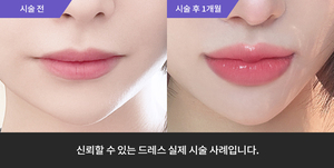 입술필러